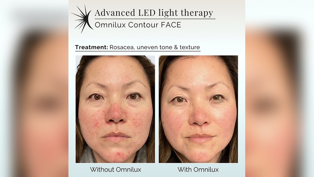 Read more about the article Do Led Face Masks Actually Work: Unveiling the Truth Today